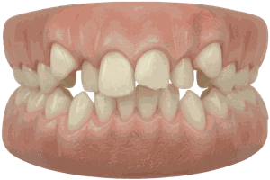 Crowded or Overlapping